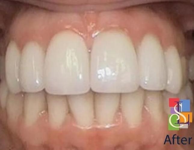 Porcelain Crowns Case 3 after