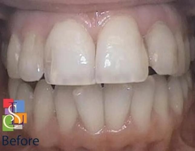 Porcelain Crowns Case 3 before