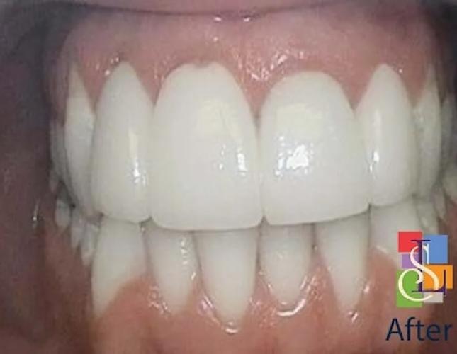 Crowns and KOR whitening after