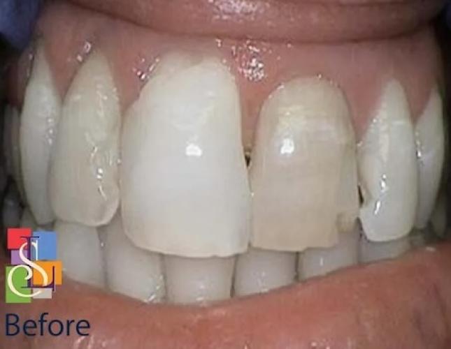 Crowns and KOR whitening before