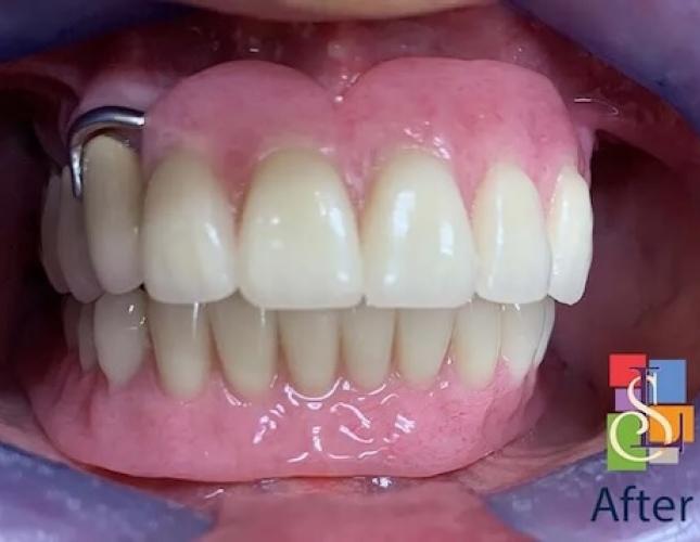 Implant Supported Dentures after