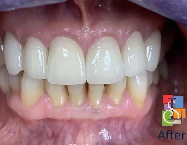 Porcelain Crowns Case 1 after Porcelain Crowns Case 1 after