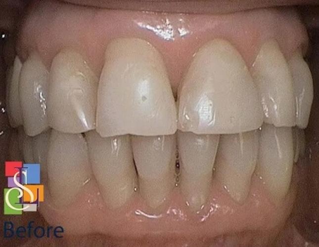 Porcelain Crowns Case 1 before Porcelain Crowns Case 1 before