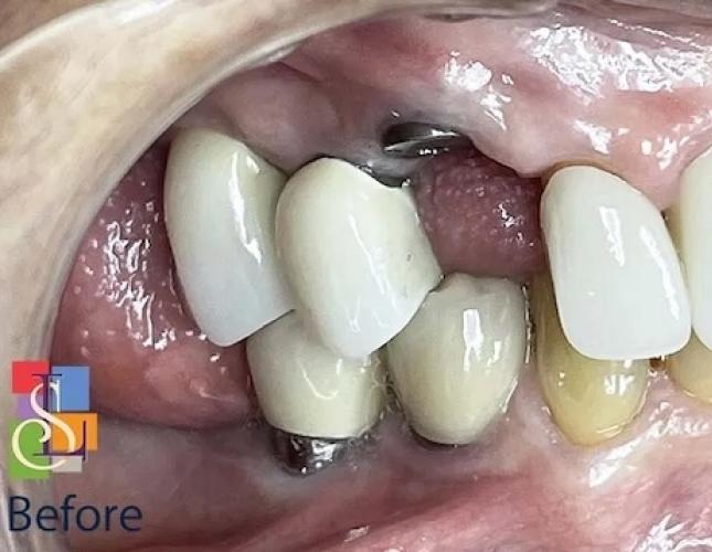 Single Tooth Replacement before