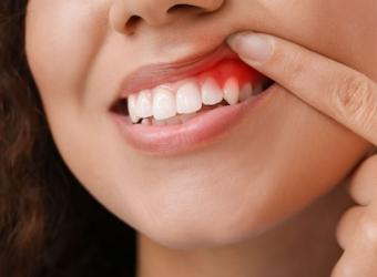 Gingivitis 101: Understanding the Basics of Gum Inflammation